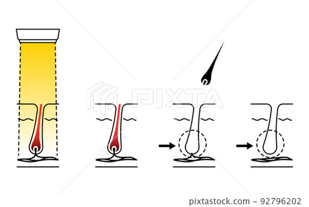 Image of hair removal, flow of hair loss after medical laser hair removal treatment 92796202