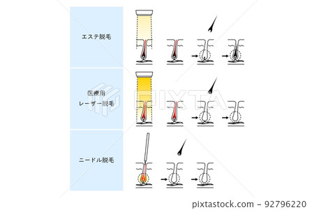 Image of hair removal, esthetic hair removal, medical laser hair removal, needle hair removal Image of hair removal, esthetic hair removal, medical laser hair removal, needle hair removal 92796220