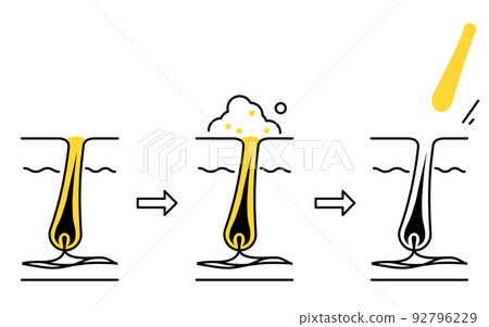 Illustration of skin care, image of cleaning pores and removing keratin plugs Illustration of skin care, image of cleaning pores and removing keratin plugs 92796229