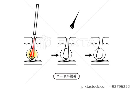 脫毛圖像，針頭脫毛後脫落的頭髮流動 92796233
