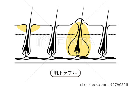 脫髮、皮膚問題、自己剃須後皮膚粗糙的形象 92796236