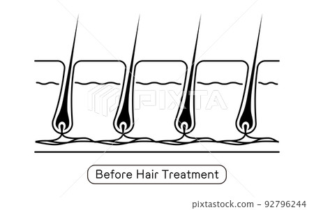 Image of hair removal, before and after hair treatment 92796244