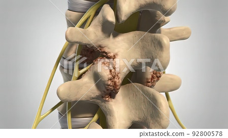 3D animated human skeleton spine degeneration in white 3D animated human skeleton spine degeneration in white 92800578
