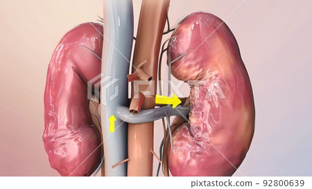 Damage to the kidneys as a result of high potassium levels in the blood. 92800639
