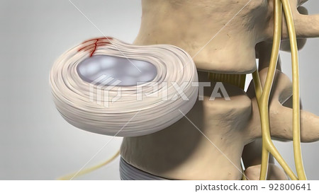 Degenerative dics disease 3d medical 92800641