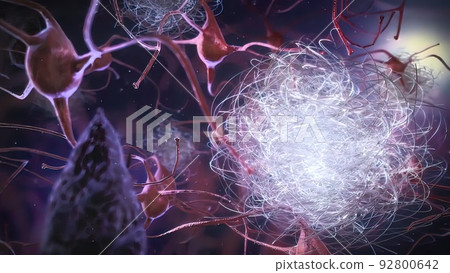 Data loss of neurons Alzheimers 92800642