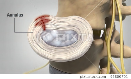 Degenerative dics disease 3d medical 92800701