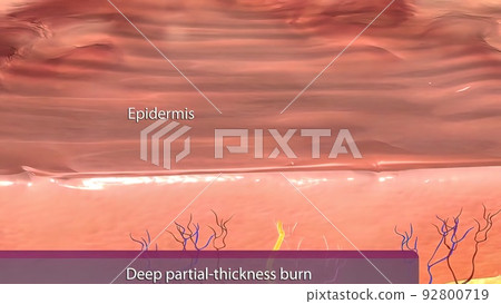 It may be red due to extravasation from damaged vessels due to damage to the dermal blood vessels. It may be red due to extravasation from damaged vessels due to damage to the dermal blood vessels. 92800719