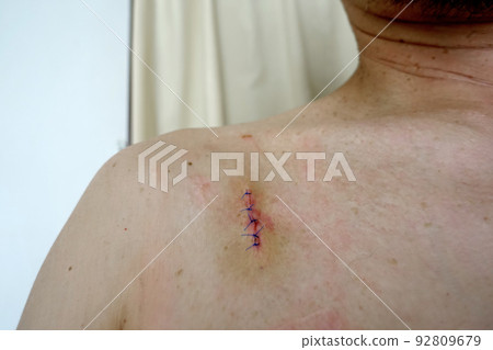 Traces of suture surgery, before suture removal Traces of suture surgery, before suture removal 92809679