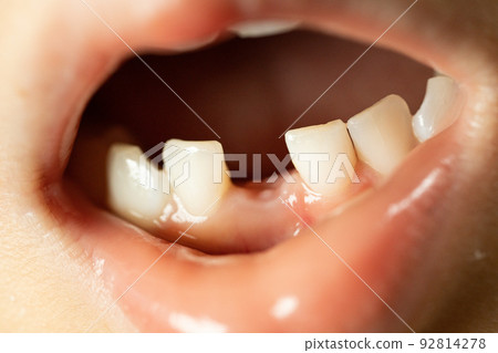 Regeneration of milk teeth Regeneration of milk teeth 92814278