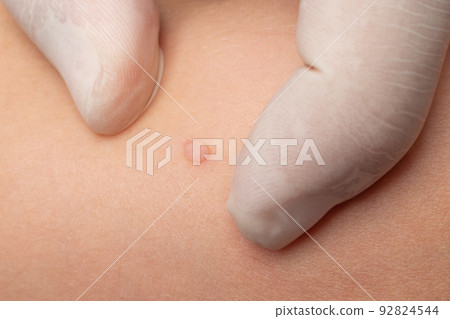 A doctor examines a wart on a child's body. 92824544