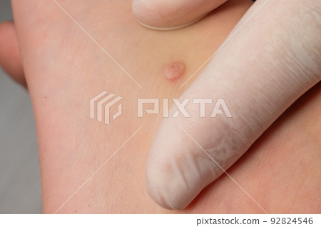 A doctor examines a wart on a child's body. 92824546