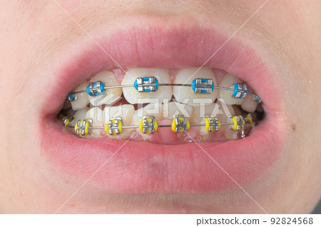 Braces with blue and yellow rubber bands close-up. 92824568