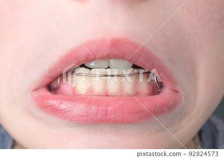 The boy wears a dental plate on his lower jaw. The boy wears a dental plate on his lower jaw. 92824573