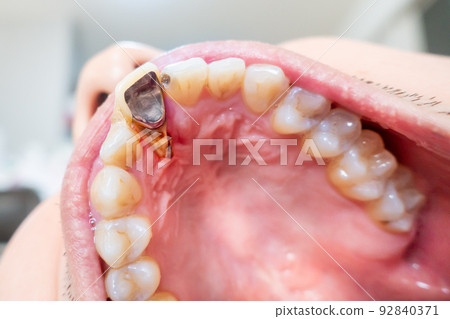 根管齲齒照片。一張牙齒露出根部的照片。可怕的蛀牙。 92840371