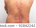 Psoriasis is that back on white background. 92842242
