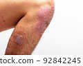 Psoriasis is that knee on white background. 92842245