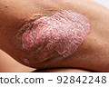 CU Shot, Psoriasis is that elbow on white background. 92842248