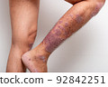 Psoriasis is that knee on white background. 92842251