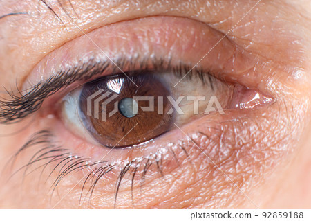 Macro photos of the human eye - cataract clouding of the lens, deterioration of vision. Treatment, surgery and ophthalmology 92859188
