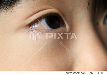 結膜水腫 92864185