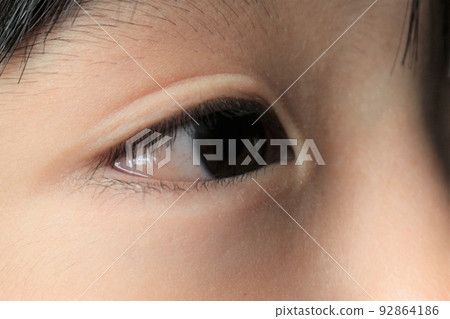 conjunctival edema 92864186
