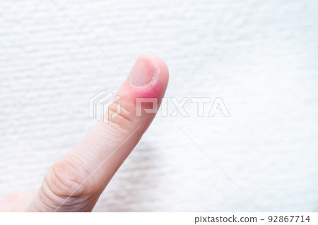 A photo of Hyokan. A photo with pus. 92867714