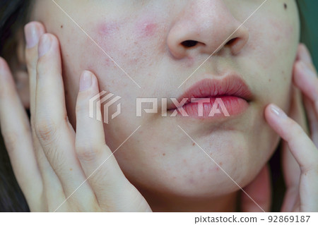 Acne pimple and scar on skin face, disorders of sebaceous glands, teenage girl skincare beauty problem. 92869187