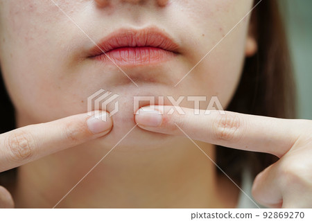 Acne pimple and scar on skin face, disorders of sebaceous glands, teenage girl skincare beauty problem. 92869270