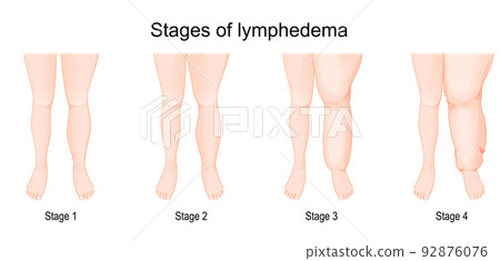 lymphedema stages. 92876076