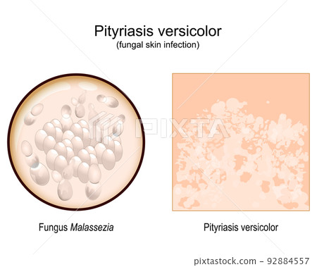 pityriasis versicolor. skin surface. Malassezia fungi 92884557