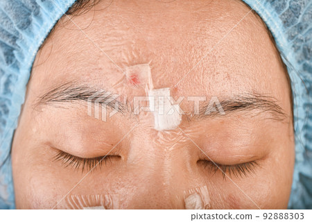 Facial skin problem, Acne disease in adult, Close up woman face with whitehead pimples Facial skin problem, Acne disease in adult, Close up woman face with whitehead pimples 92888303