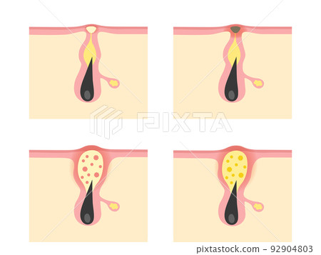 Types of acne Types of acne 92904803