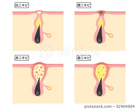 Types of acne 92904804