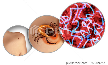 Lyme Disease 92909754