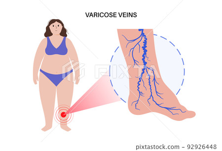 Varicose veins treatment Varicose veins treatment 92926448
