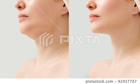 Female double chin before and after correction. Correction of the chin shape liposuction of the neck. The result of the procedure in the clinic of aesthetic medicine. Female double chin before and after correction. Correction of the chin shape liposuction of the neck. The result of the procedure in the clinic of aesthetic medicine. 92937787
