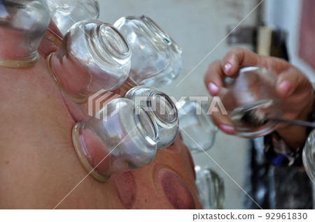 Multiple vacuum cup of medical cupping therapy on human body 92961830
