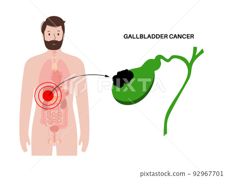 gallbladder cancer anatomy gallbladder cancer anatomy 92967701