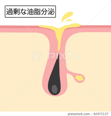 Image illustration of excessive secretion of sebum Image illustration of excessive secretion of sebum 92973137