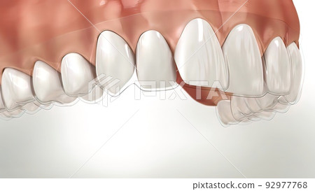 Invisalign braces or invisible retainer make bite correction. Medically accurate 92977768