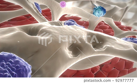 Disrupting bone structure, Rheumatoid Arthritis 92977777