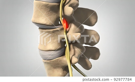 Disc shifting and nerve entrapment 92977784