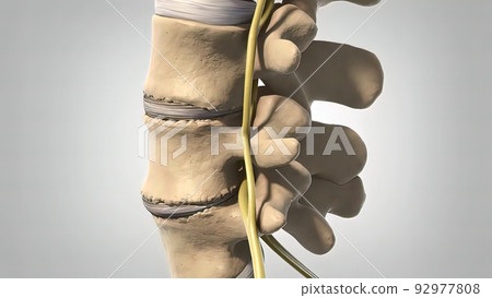 Degenerative Spondylolisthesis 3d illustration 92977808