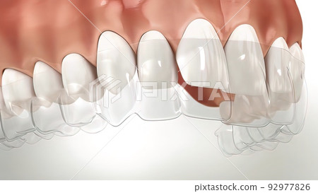 Invisalign braces or invisible retainer make bite correction. Medically accurate Invisalign braces or invisible retainer make bite correction. Medically accurate 92977826