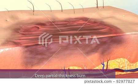 It may be red due to extravasation from damaged vessels due to damage to the dermal blood vessels. It may be red due to extravasation from damaged vessels due to damage to the dermal blood vessels. 92977827