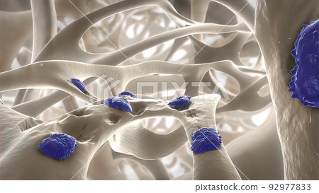 Disrupting bone structure, Rheumatoid Arthritis 92977833