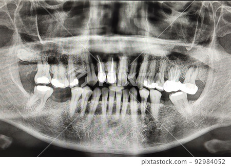 Panoramic radiograph skull full mouth x-ray human disease oral surgery dentistry teeth patient care 92984052