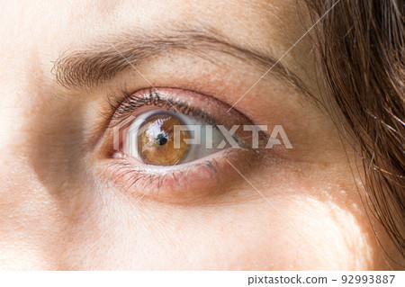 Human eye with lens close-up macro. Ophthalmology, correction of myopia or hyperopia. Human eye with lens close-up macro. Ophthalmology, correction of myopia or hyperopia. 92993887