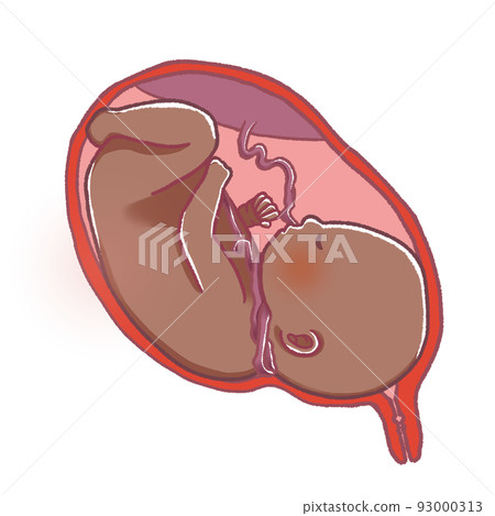 Umbilical cord winding A baby with an umbilical cord wrapped around its neck 93000313